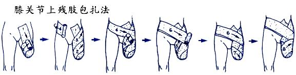 手术后的硬质包扎法以及压迫性缠绕法