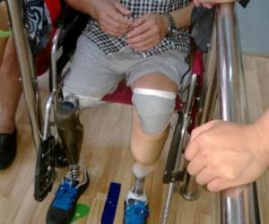 小腿假肢 小腿假肢